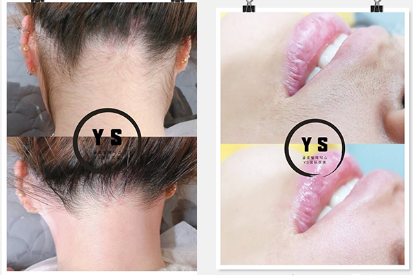  花季传媒APP网站免费进入YS水晶脱毛与传统蜜蜡脱毛的区别